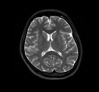 Mindst absorberende kontrollere Brain - The MRI Center