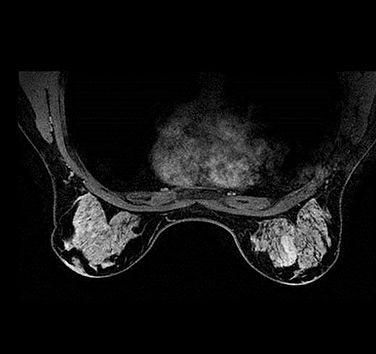 Breast MRI Scan