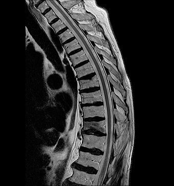 Spine MRI Scan