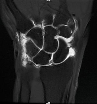 MRI Arthrogram